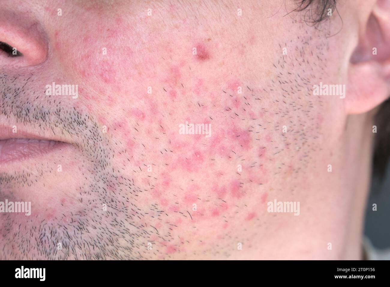 Dermatitis on man face. Eczema close up. Stock Photo
