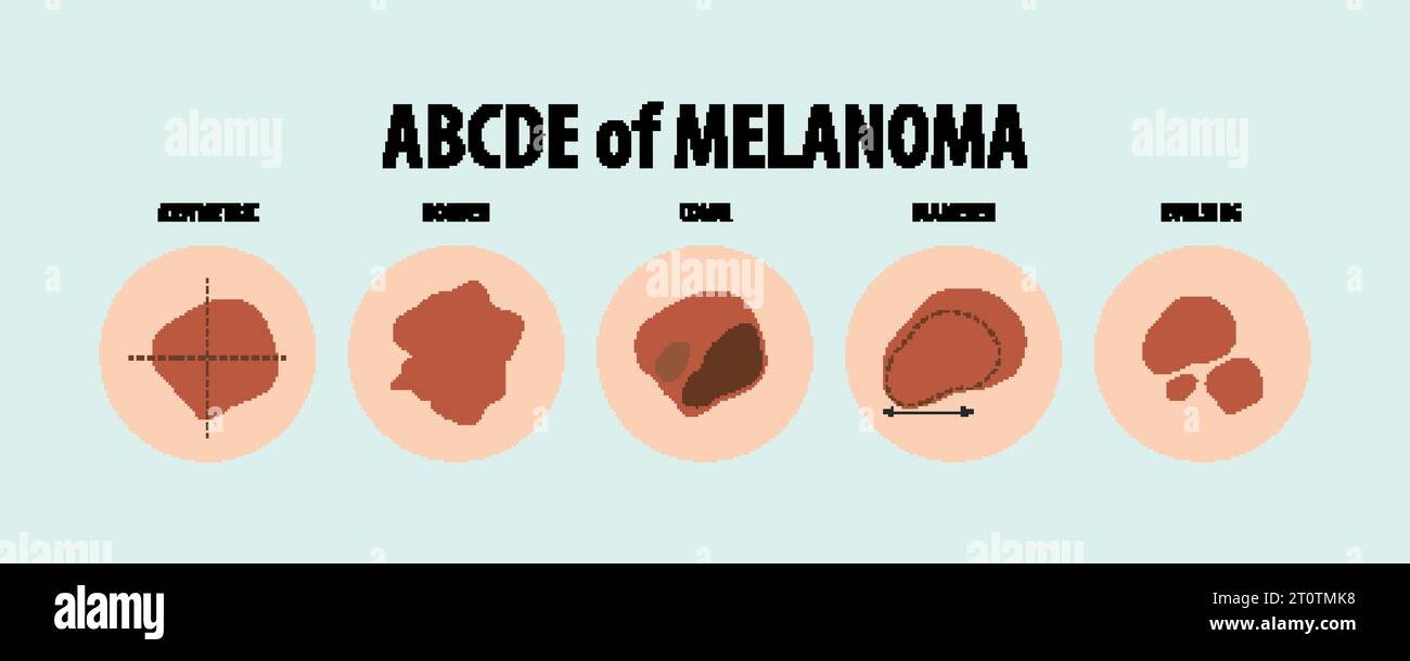 Learn about different types of skin cancer through vector illustrations ...