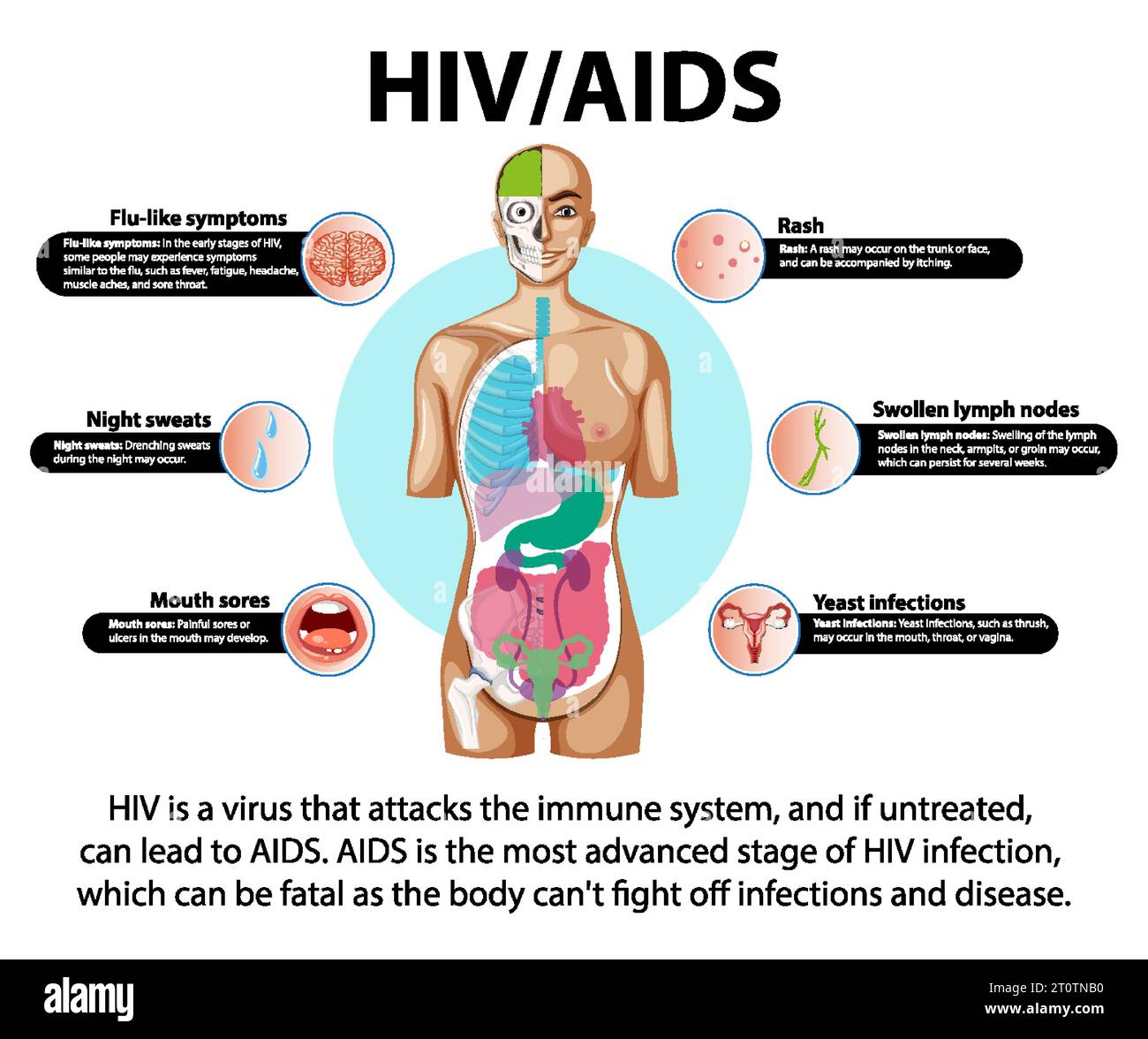 Illustration Depicting How HIV AIDS Virus Attacks The Immune System And 