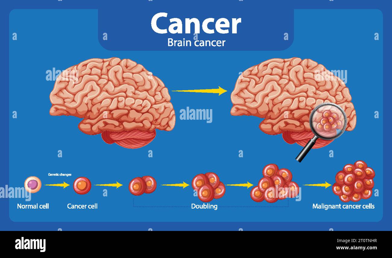 Illustrated guide to brain cancer and abnormal cell development Stock ...