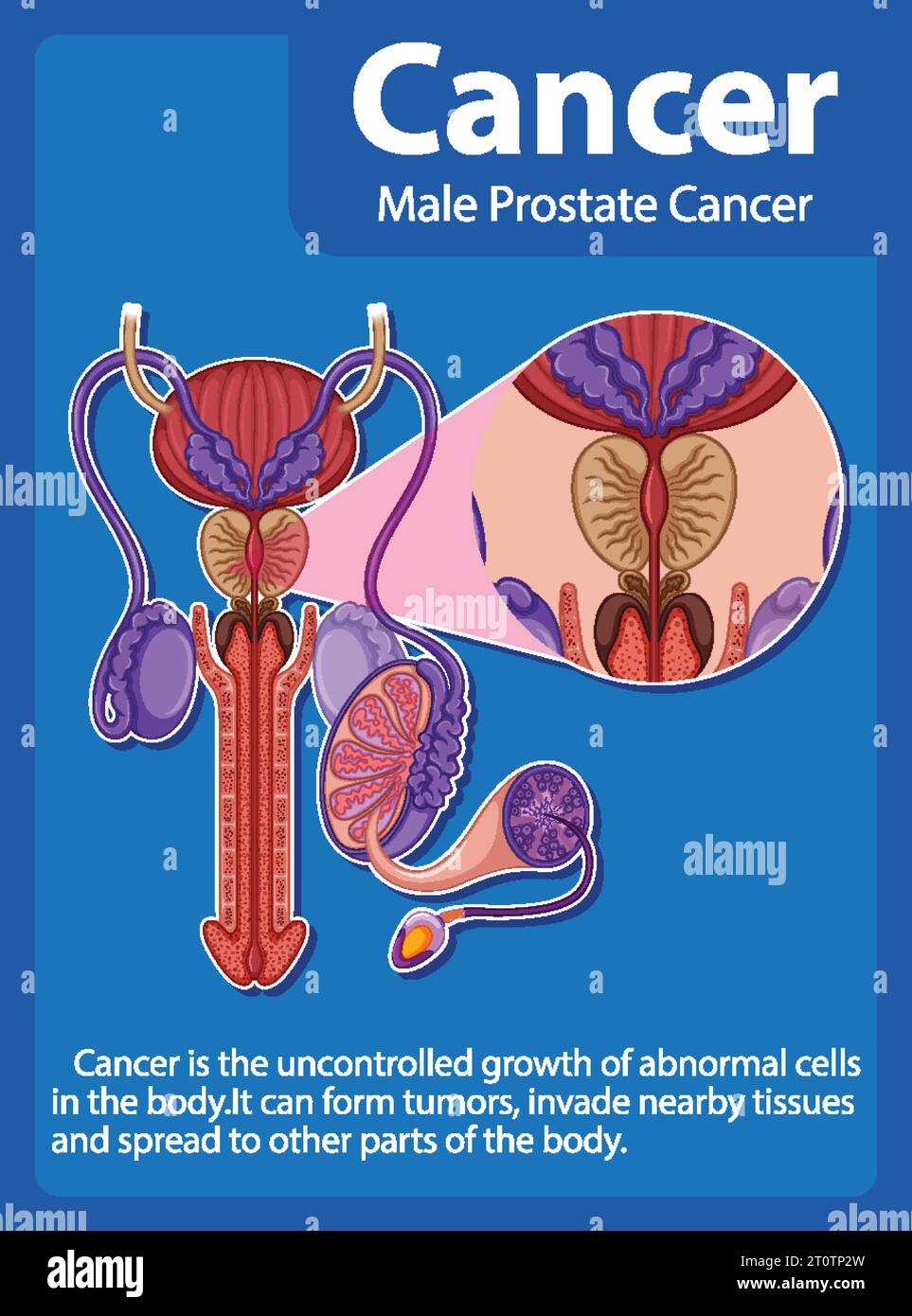 Infographic illustrating the differences between normal and cancerous prostate cells Stock Vector