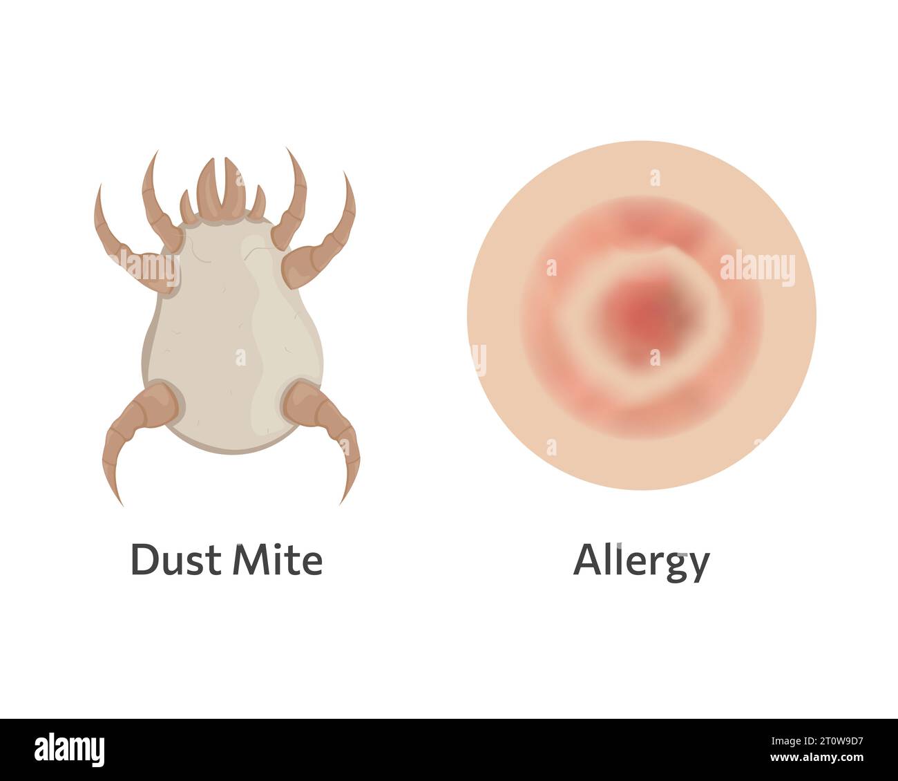 Skin allergy to dust mites vector illustration design Stock Vector Image & Art Alamy