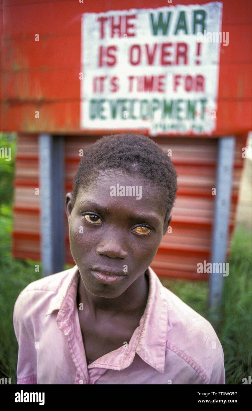 Liberia, Monrovia; boy with one eye blind in front of a sign saying ...