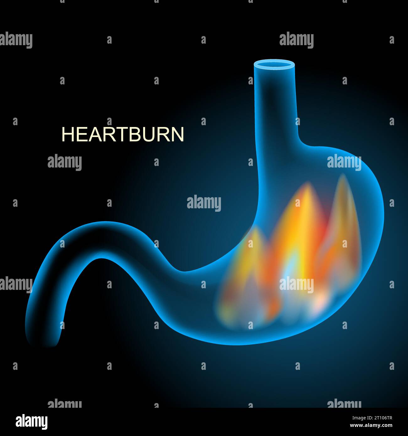 Heartburn. Pyrosis, cardialgia or acid indigestion. burning sensation in the stomach. Gastroesophageal reflux disease GERD. Blue realistic stomach wit Stock Vector