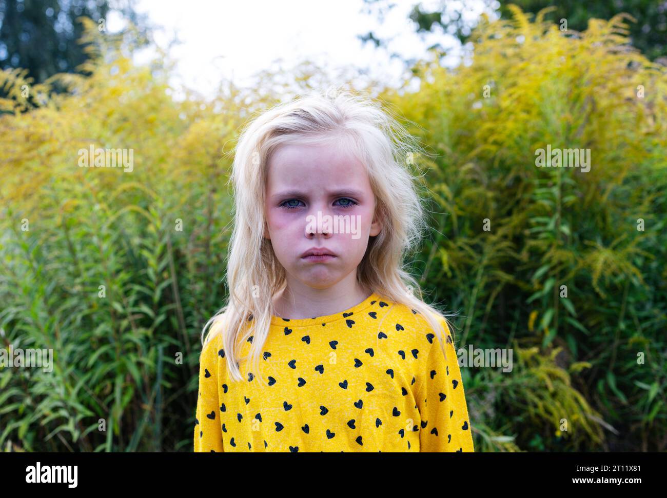 sad child looking sick with red watery eyes and runny nose caused by