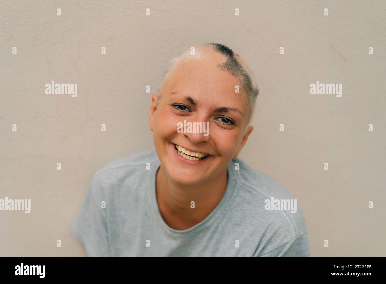 Real alopecia areata in a young girl. A bald head in a person. Diffuse