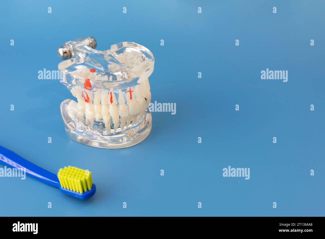 Pathological Tooth Transparent Pathological Tooth Model. Dental Education Implant ...