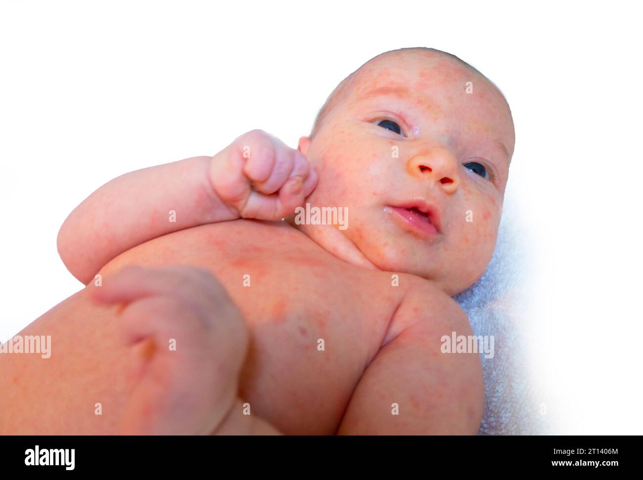 baby allergy skin food. child dermatitis symptom problem rash. miliaria