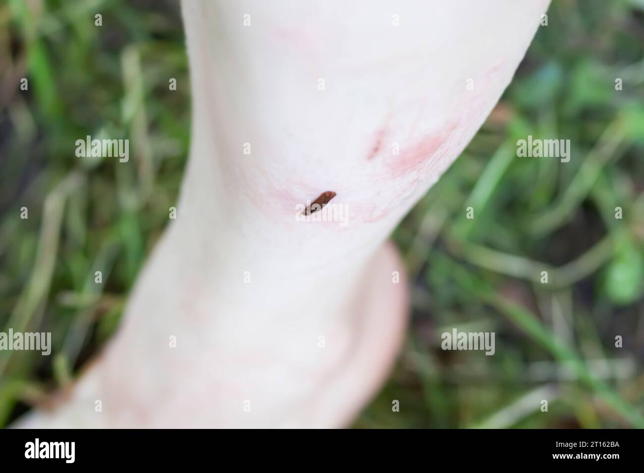A leech bites a woman's leg Stock Photo Alamy