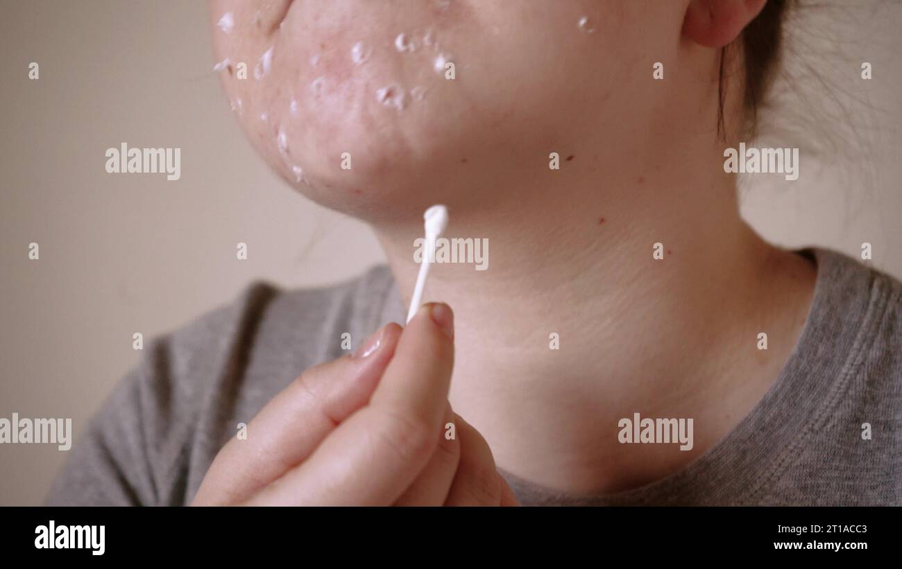 Pig Demodex Rash Close up of skin problems, unhealthy skin with acne and pimples. Porous ...