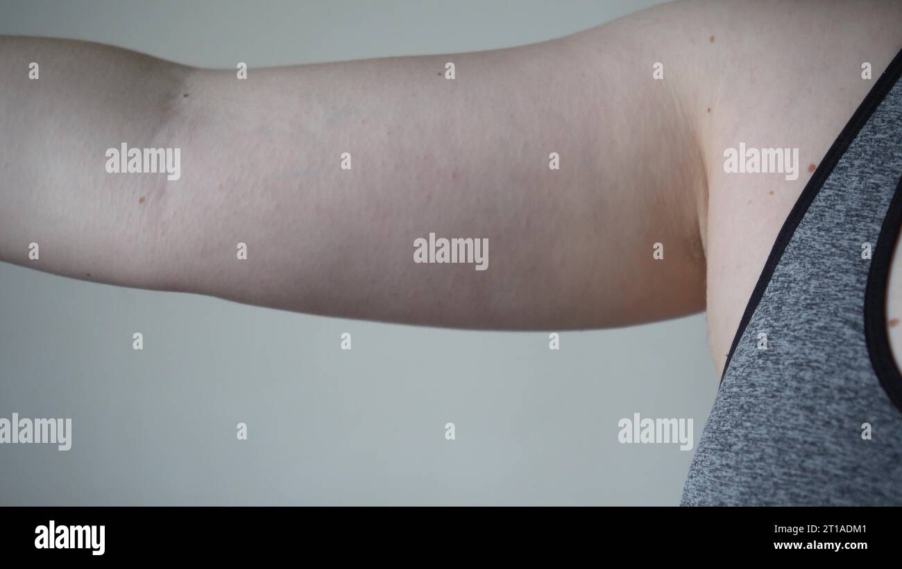 Lightskinned young woman with drooping arms. Sad bad body shape girl