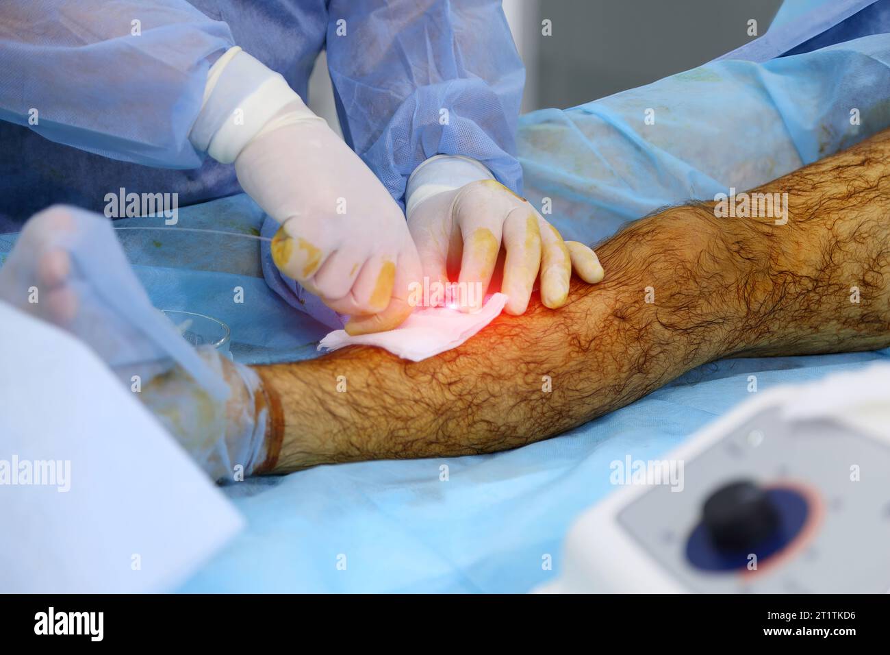 Medical surgery for endovenous laser photocoagulation of the great
