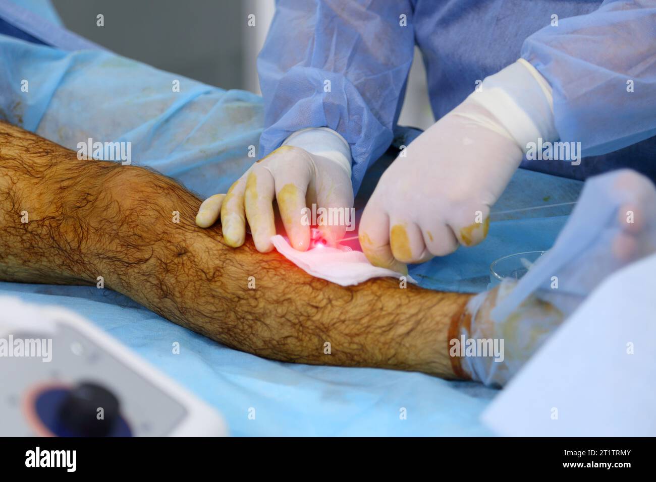 Medical surgery for endovenous laser photocoagulation of the great