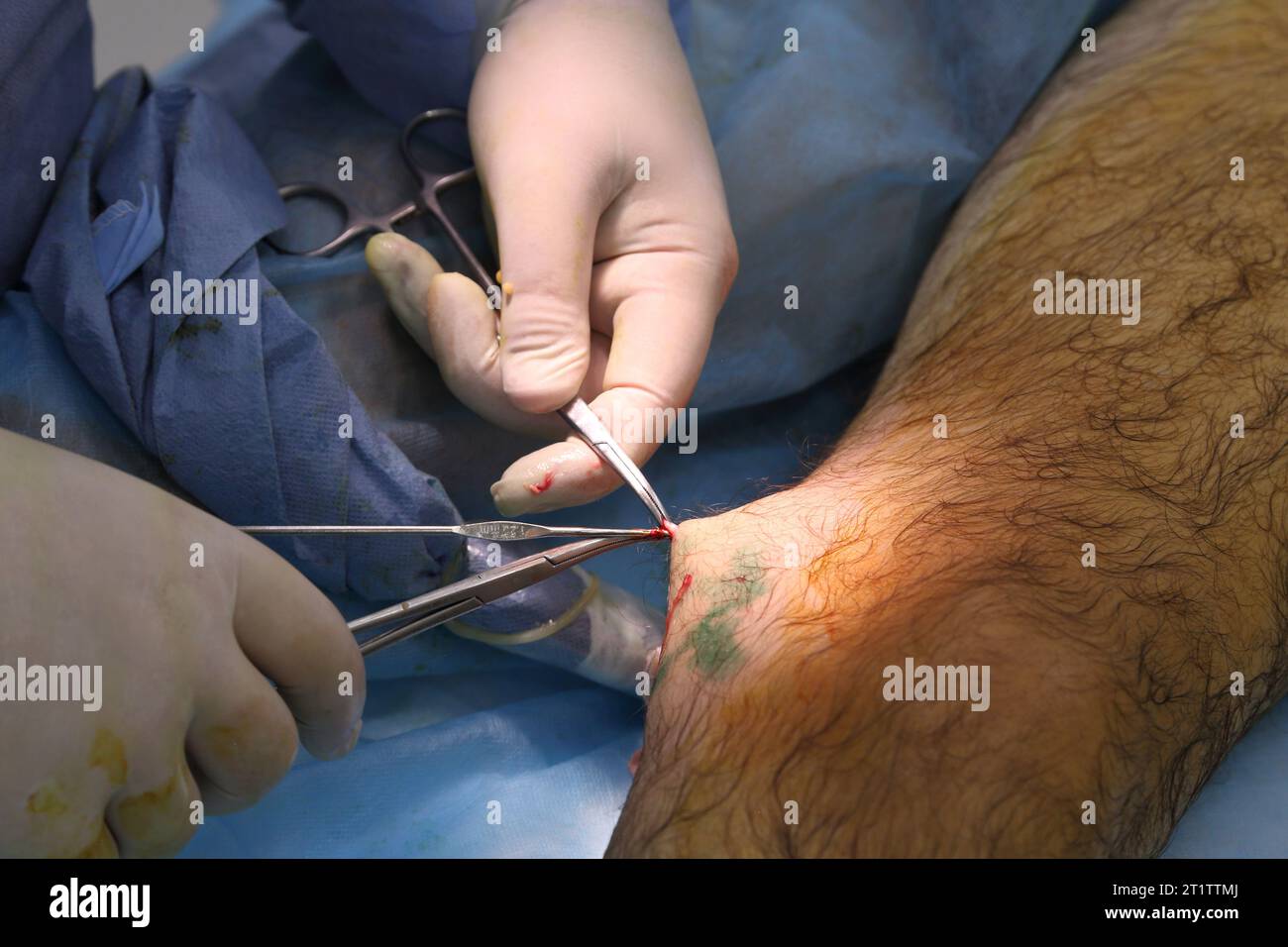 Medical surgery for endovenous laser photocoagulation of the great saphenous vein. Miniphlegectomy. Endovenous laser coagulation vein. Stock Photo