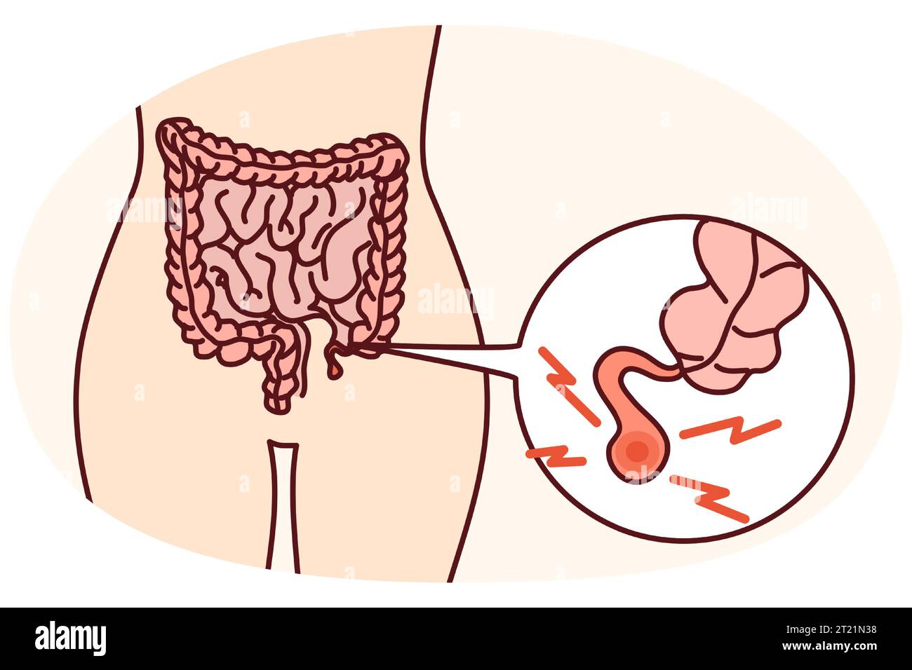 Closeup of human body with inflamed appendix. Person suffer from ...