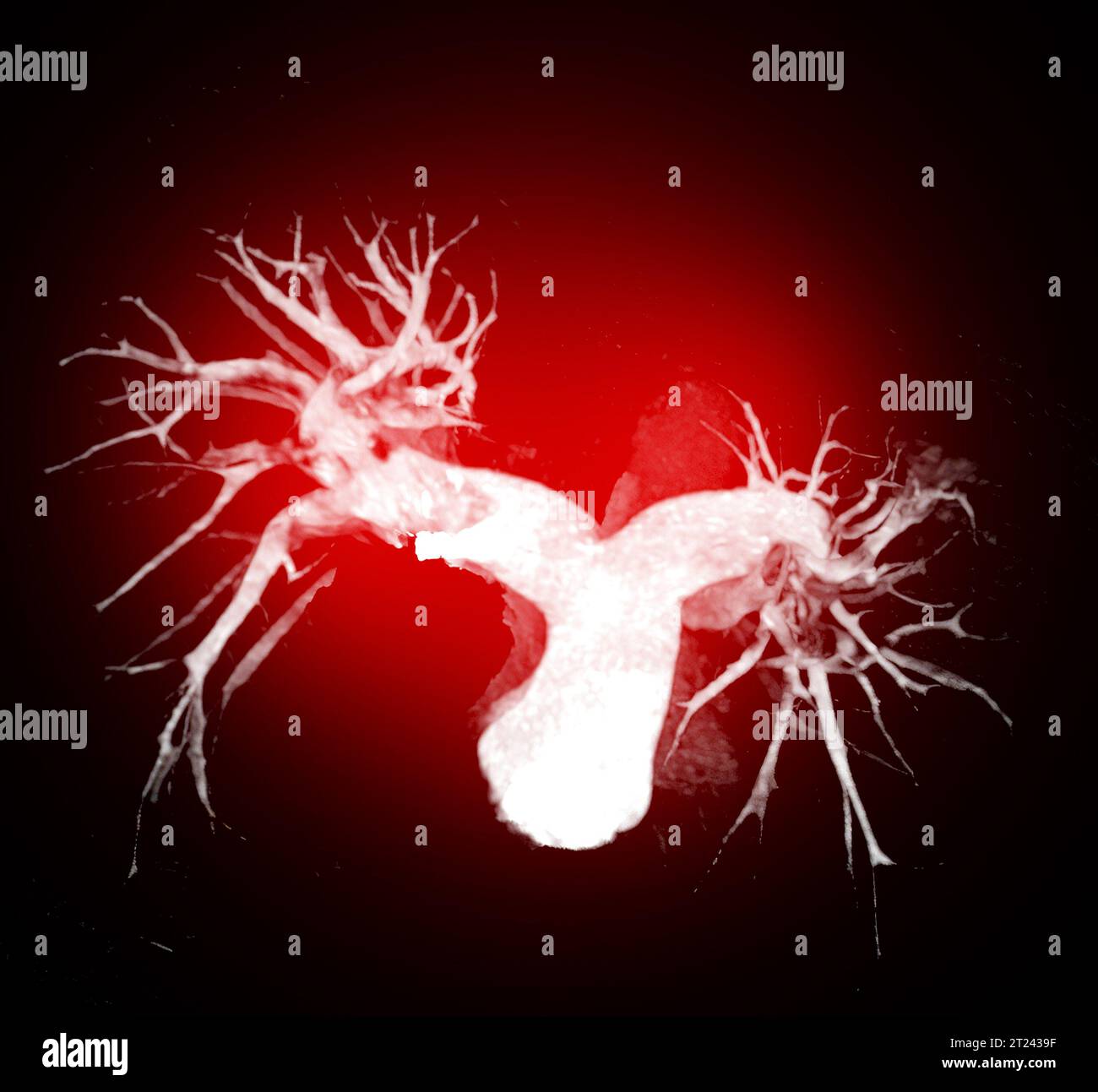 CTA Chest or CTPA with contrast media 3D rendering for diagnostic ...