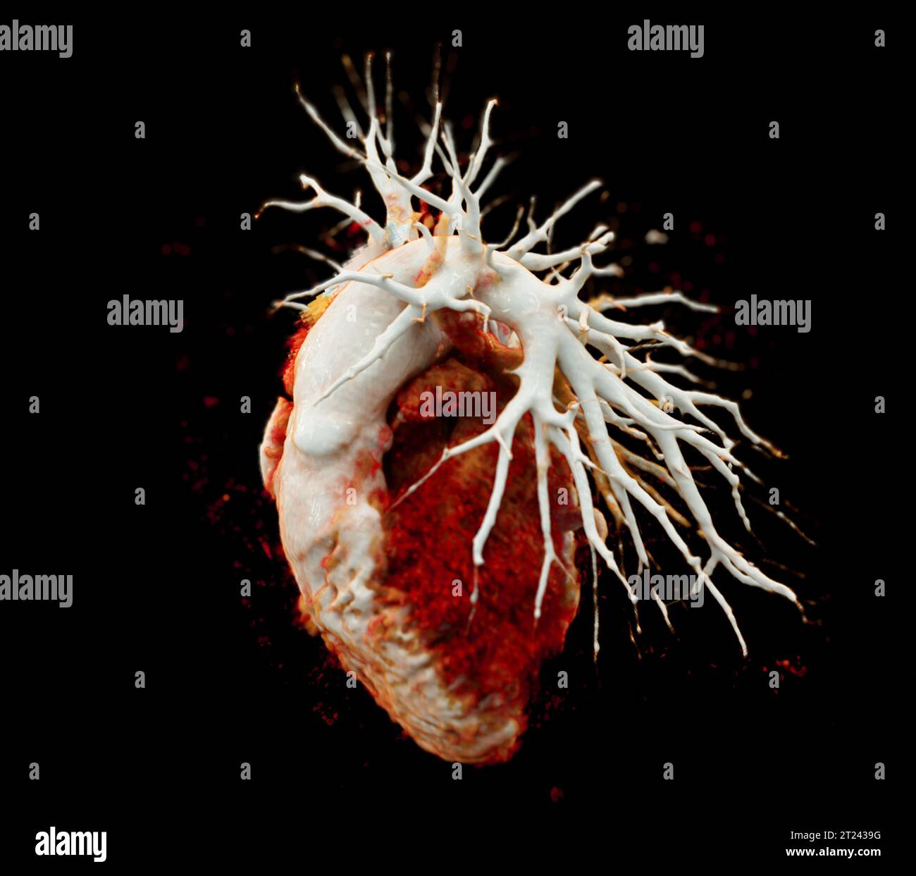 CTA Chest  or CTPA with contrast media 3D rendering  for diagnostic Pulmonary embolism (PE) . Stock Photo