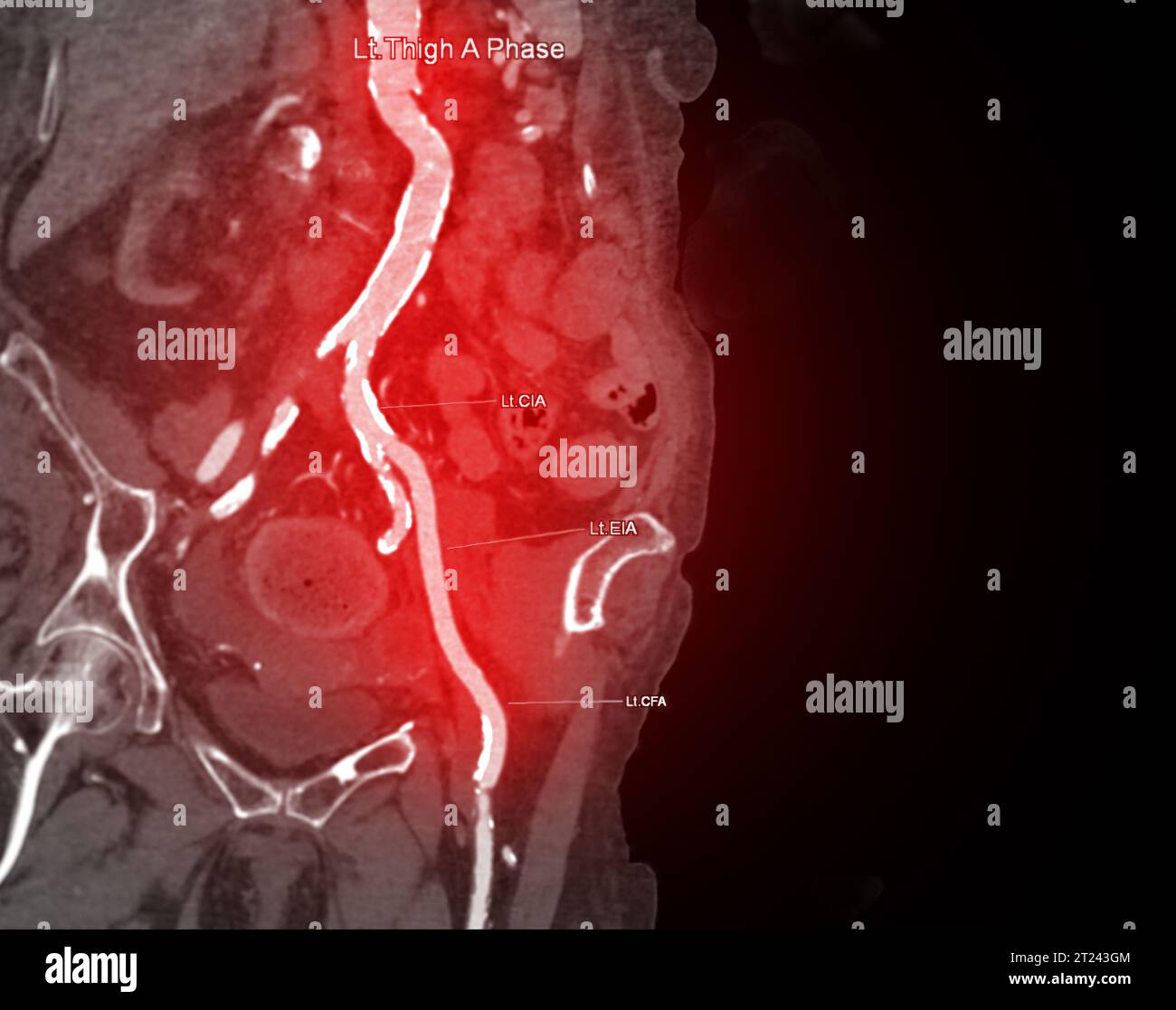 CTA femoral artery run off image of femoral artery for diagnosis Acute ...