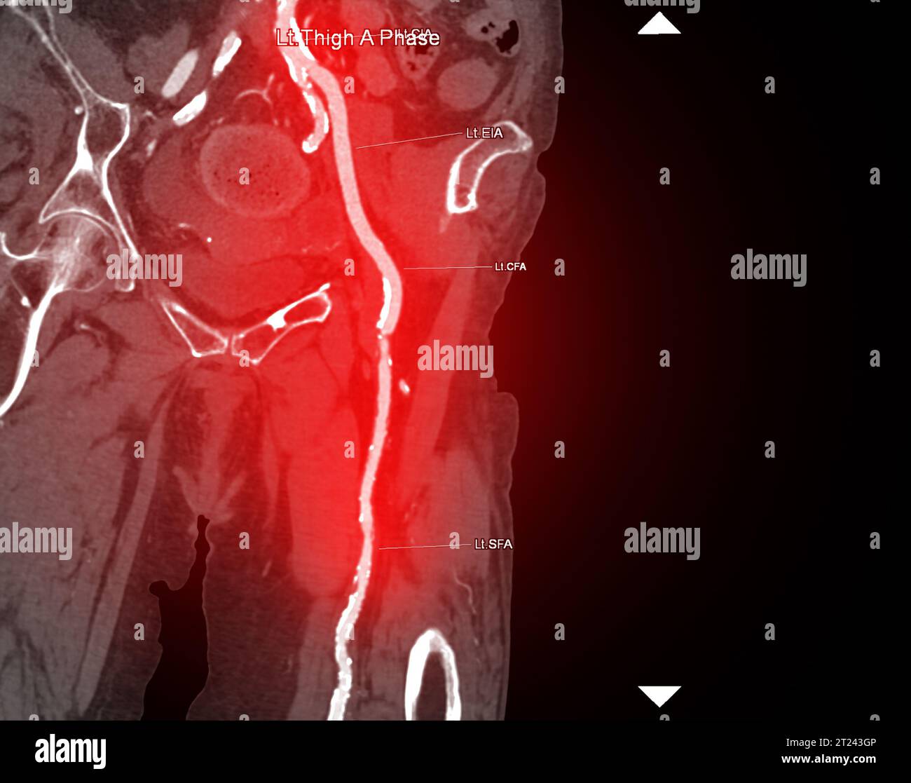 CTA femoral artery run off image of femoral artery for diagnosis Acute