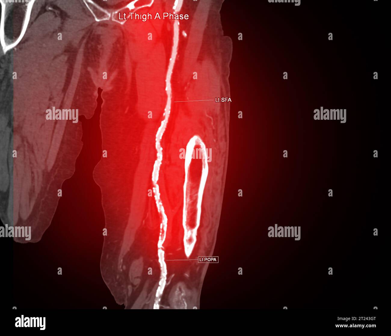 CTA femoral artery run off image of femoral artery for diagnosis Acute ...