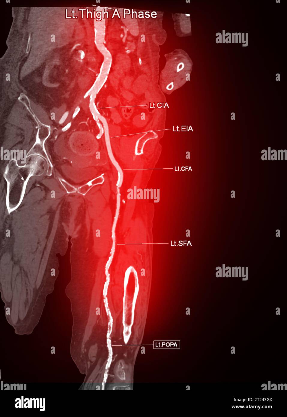 CTA femoral artery run off image of femoral artery for diagnosis Acute
