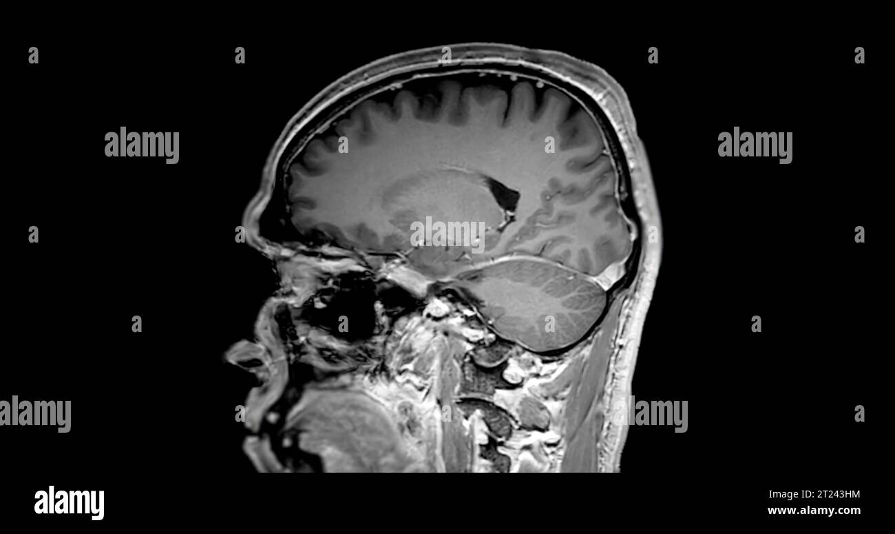 MRI  brain sagittal t1w  with gadolinium  showing normal brain. Stock Photo