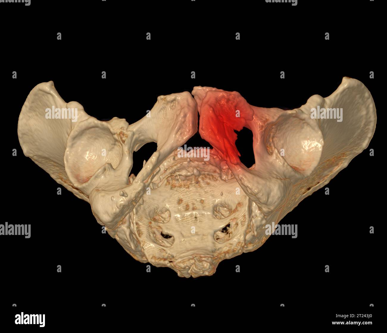 CT Scan of pelvic bone 3D rendering image showing superior pubic ramus