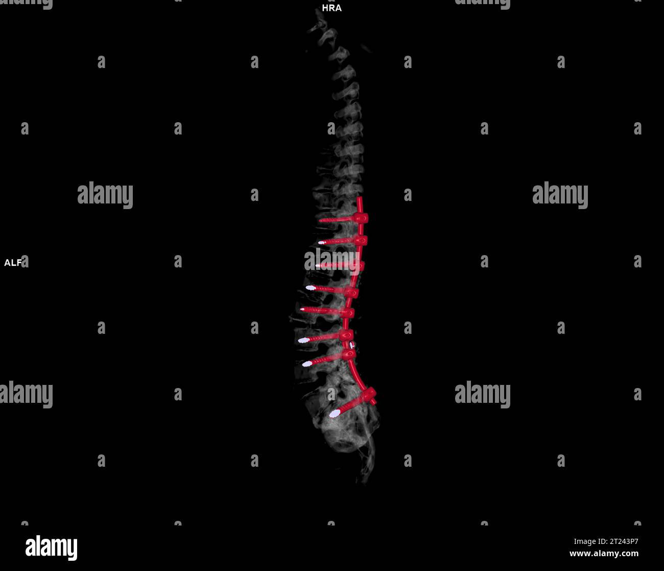 CT scan of thoracic and lumbar spine 3d rendering showing pedicle screw ...