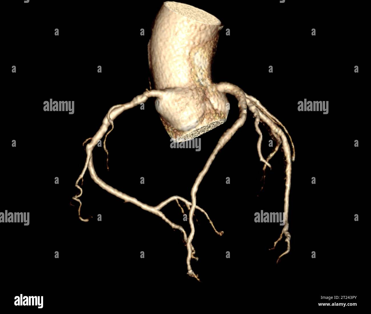 CTA Coronary artery  3D rendering image. CT angiographphy for heart disease . Stock Photo