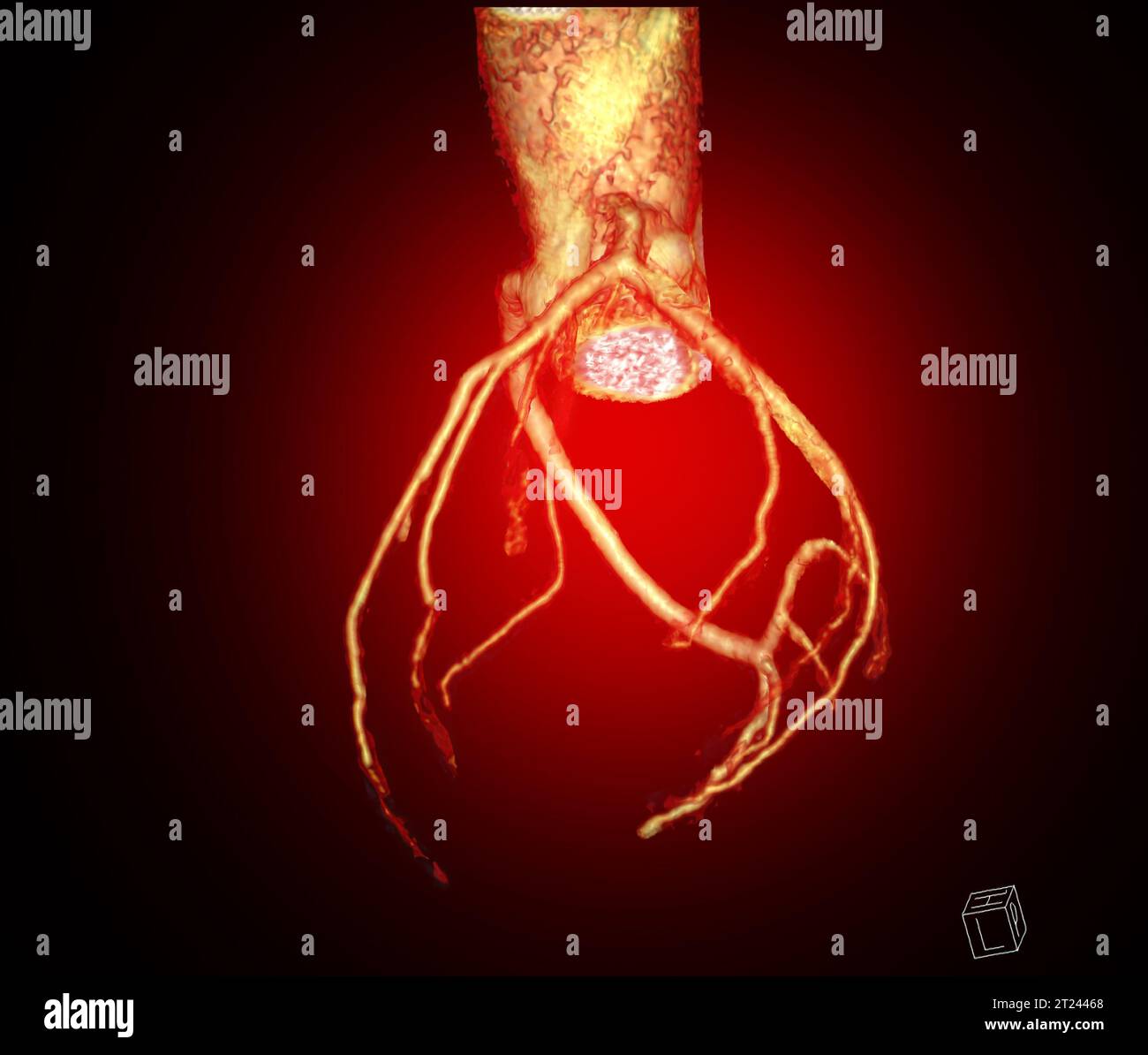 CTA Coronary artery  3D rendering image. CT angiographphy for heart disease . Stock Photo