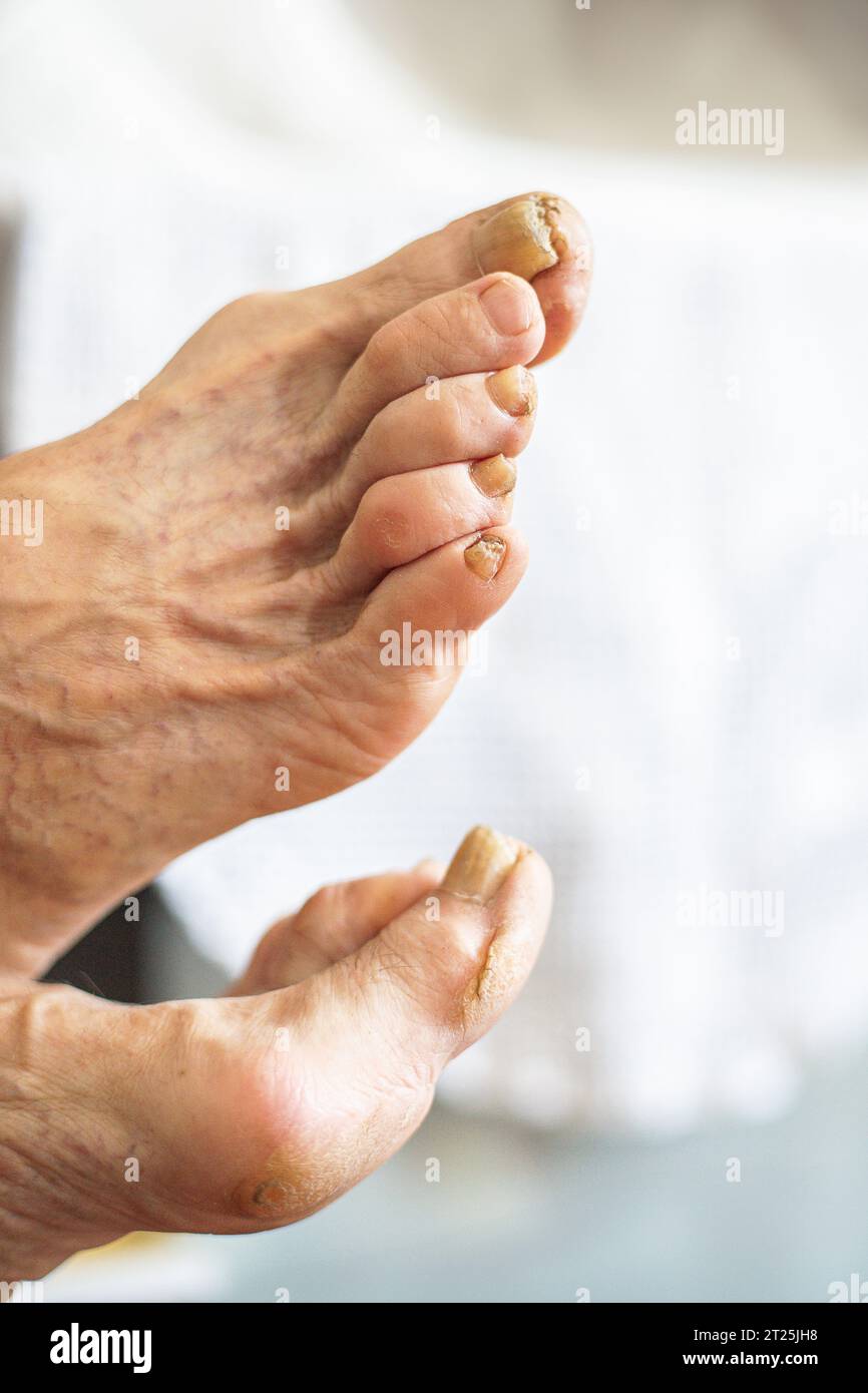 Close up of adult feet with various problems, calluses, dry skin, bunions, nails with mycoses and varicose veins. Stock Photo