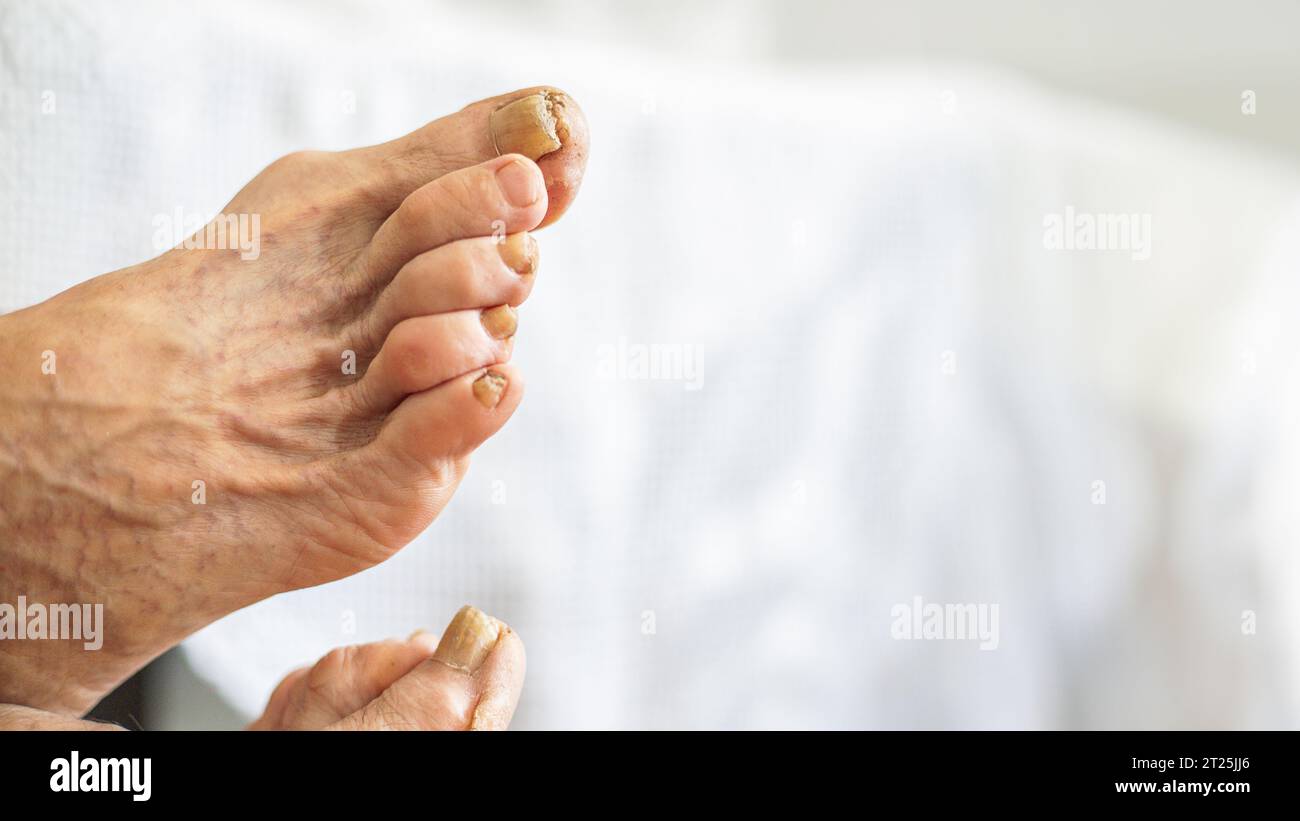 Close up of adult feet with various problems, calluses, dry skin, bunions, nails with mycoses and varicose veins. Stock Photo