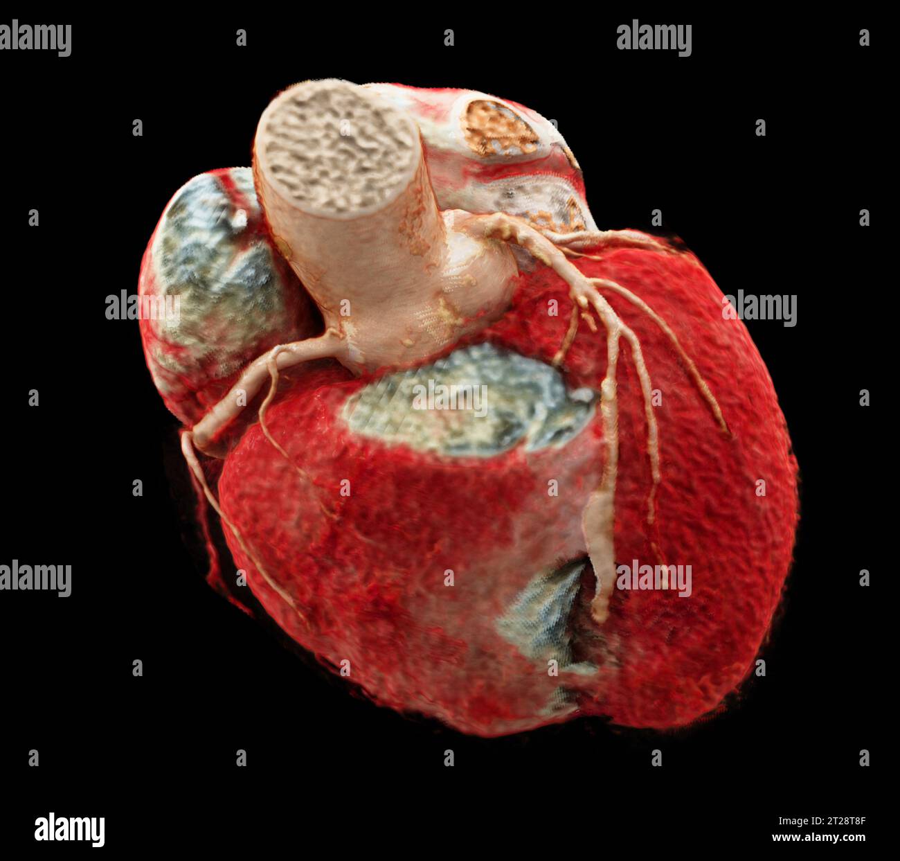 CTA Coronary artery 3D rendering image showing coronary tree and heart ...