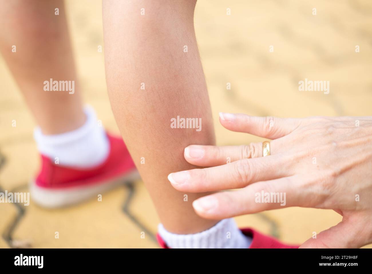 A mother's hand applies medicine to relieve itching from a mosquito ...