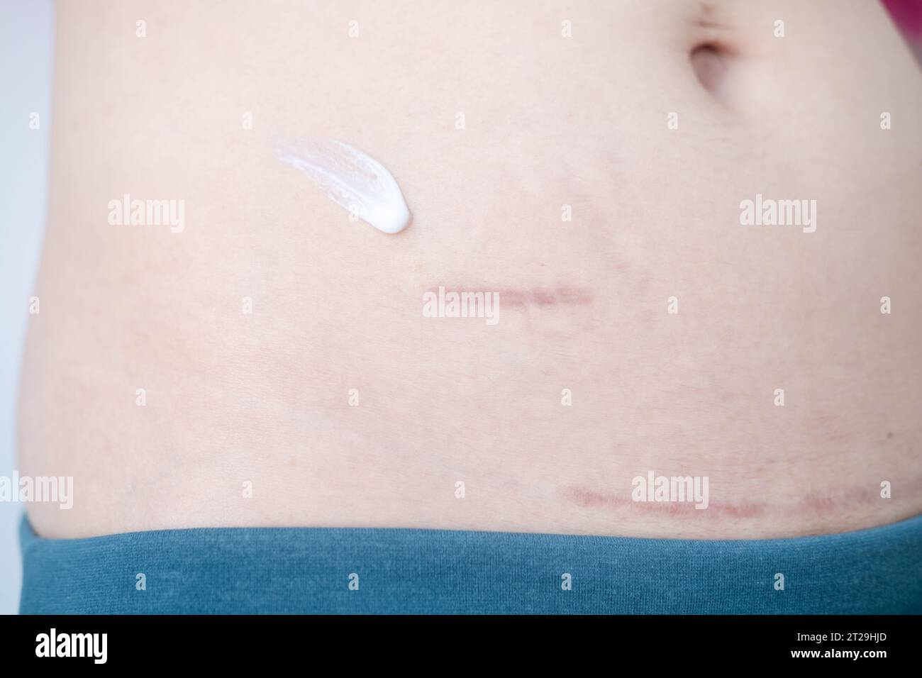 Using cream to care for scars after appendix surgery and postpartum