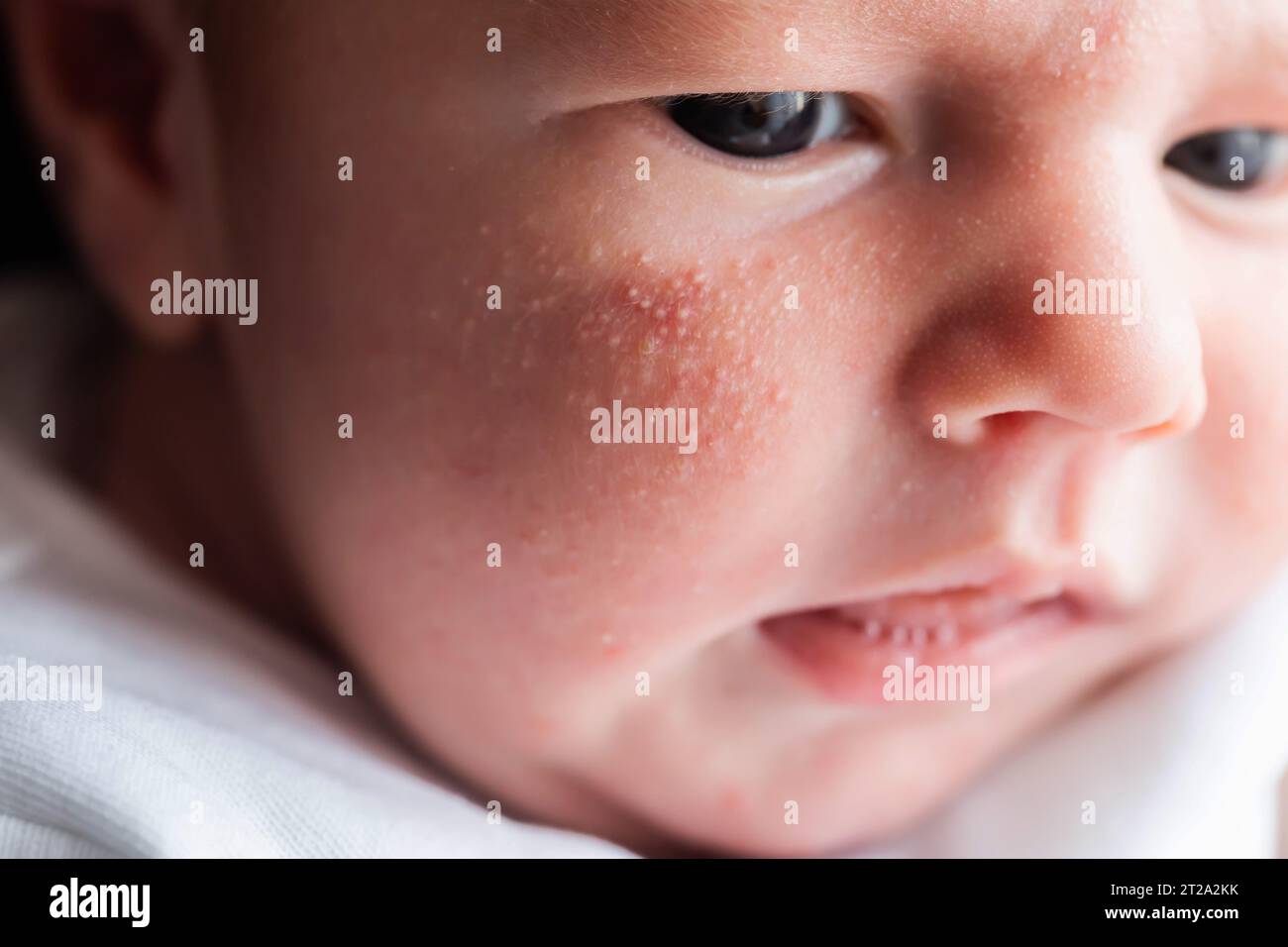 Allergic pimples in a newborn on the face. Pathogenesis, acne of