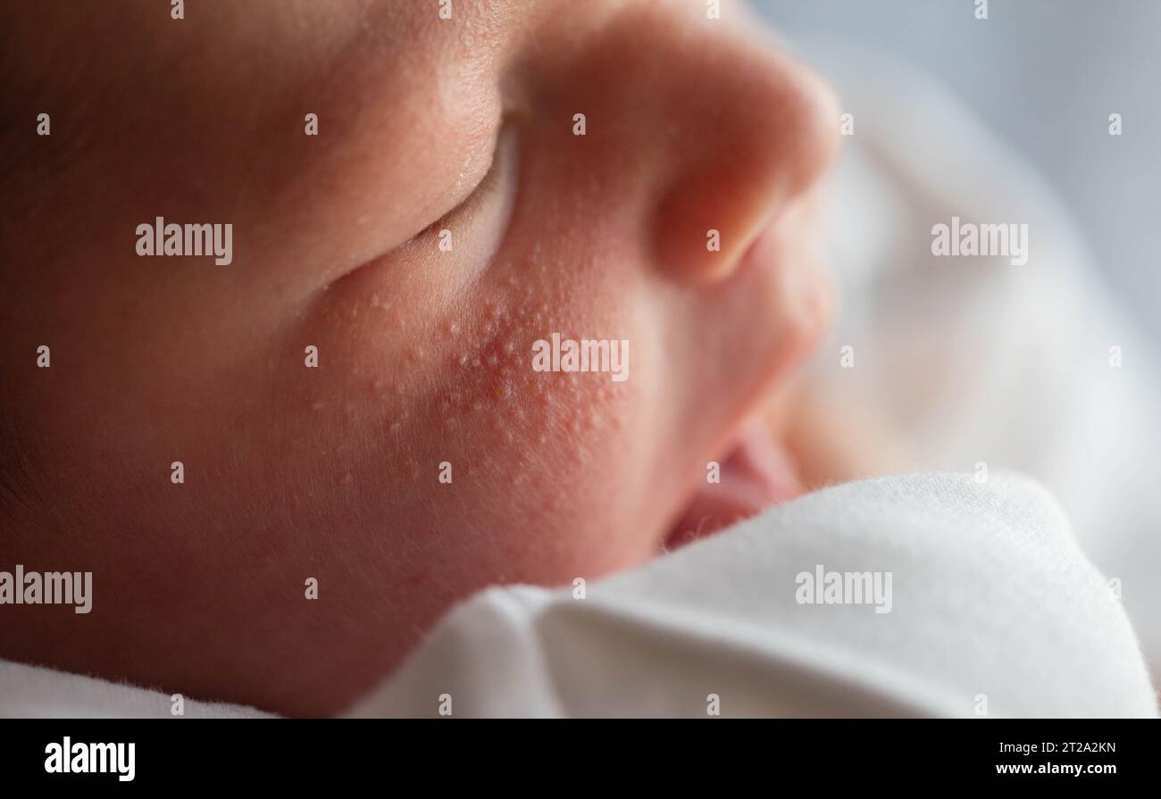 Pimples on the face of a newborn. Baby's adaptation to the environment