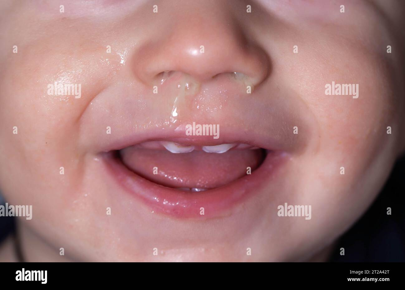 Closeup of a child's face, nose with snot and teething in the child's