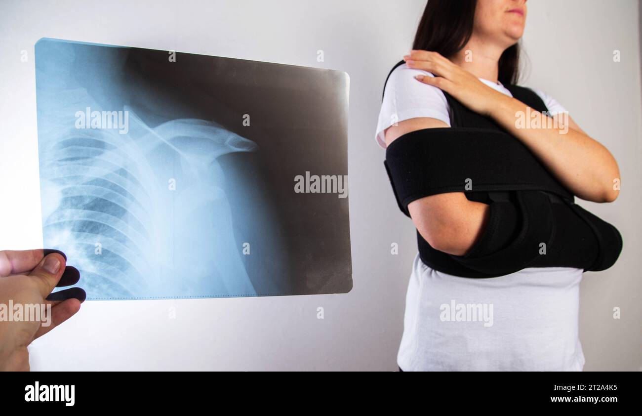 The doctor holds in his hand a medical x-ray of a dislocated humerus and a fractured collarbone against the background of a girl patient whose shoulde Stock Photo