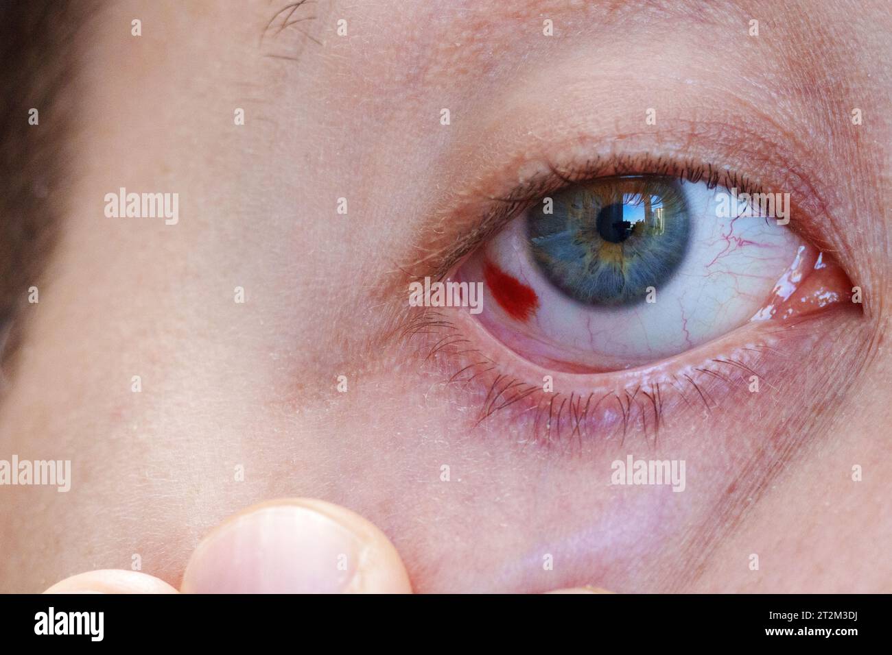 Bloodshot eye. Man, a very red, bleeding eyeball. Bleeding eye injury