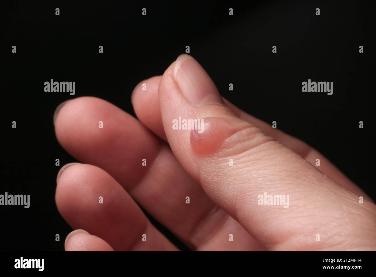 Hygroma (Ganglion cyst) of the thumb joint. Selective focus Stock Photo