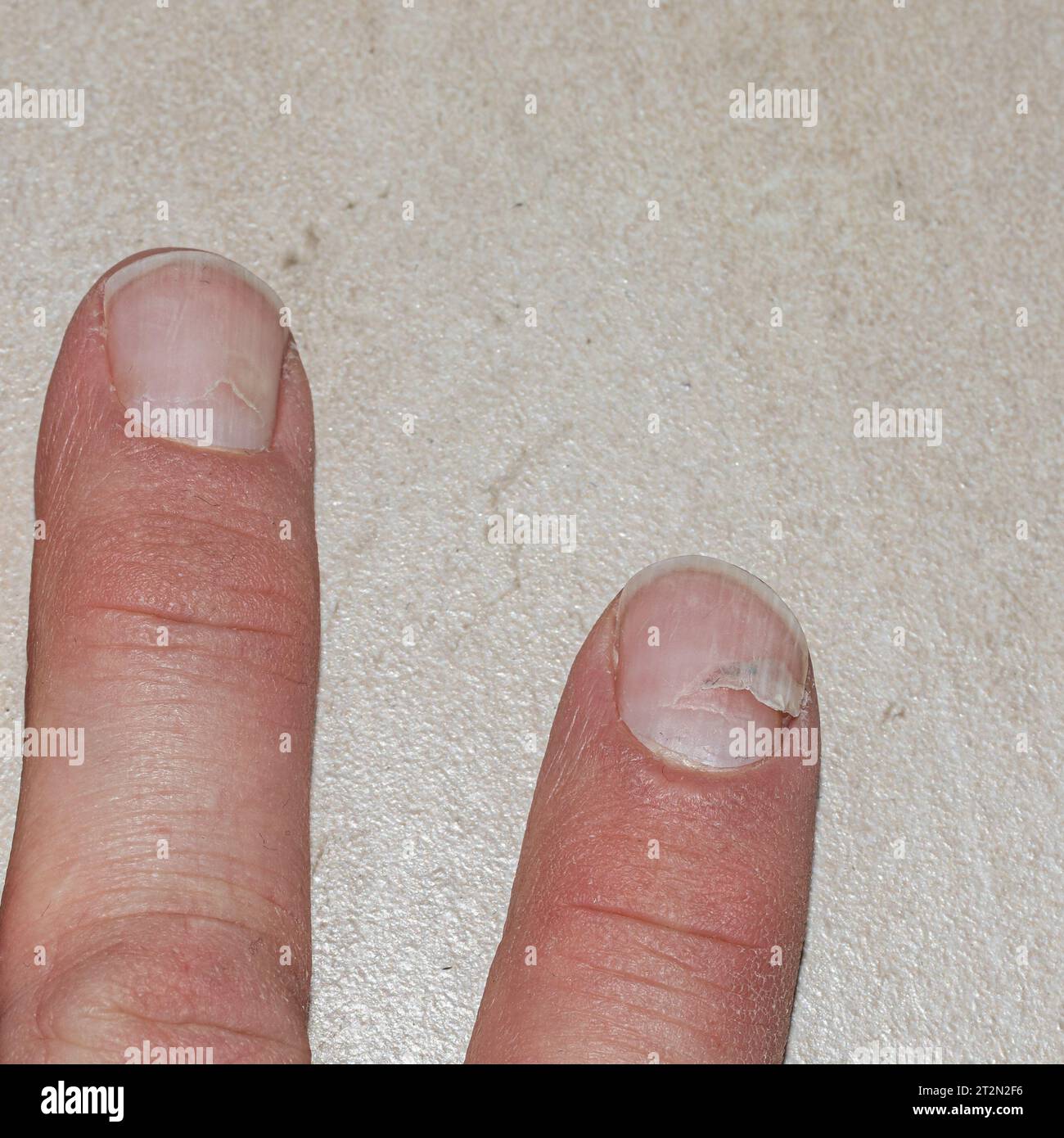 A hand affected by scarlet fever, revealing the resilience of the nails as they heal from the condition Stock Photo