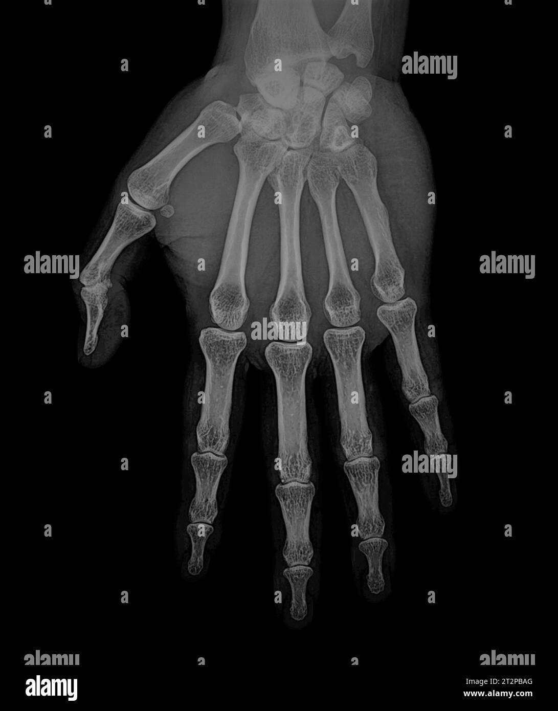 Healthy hand, X-ray Stock Photo