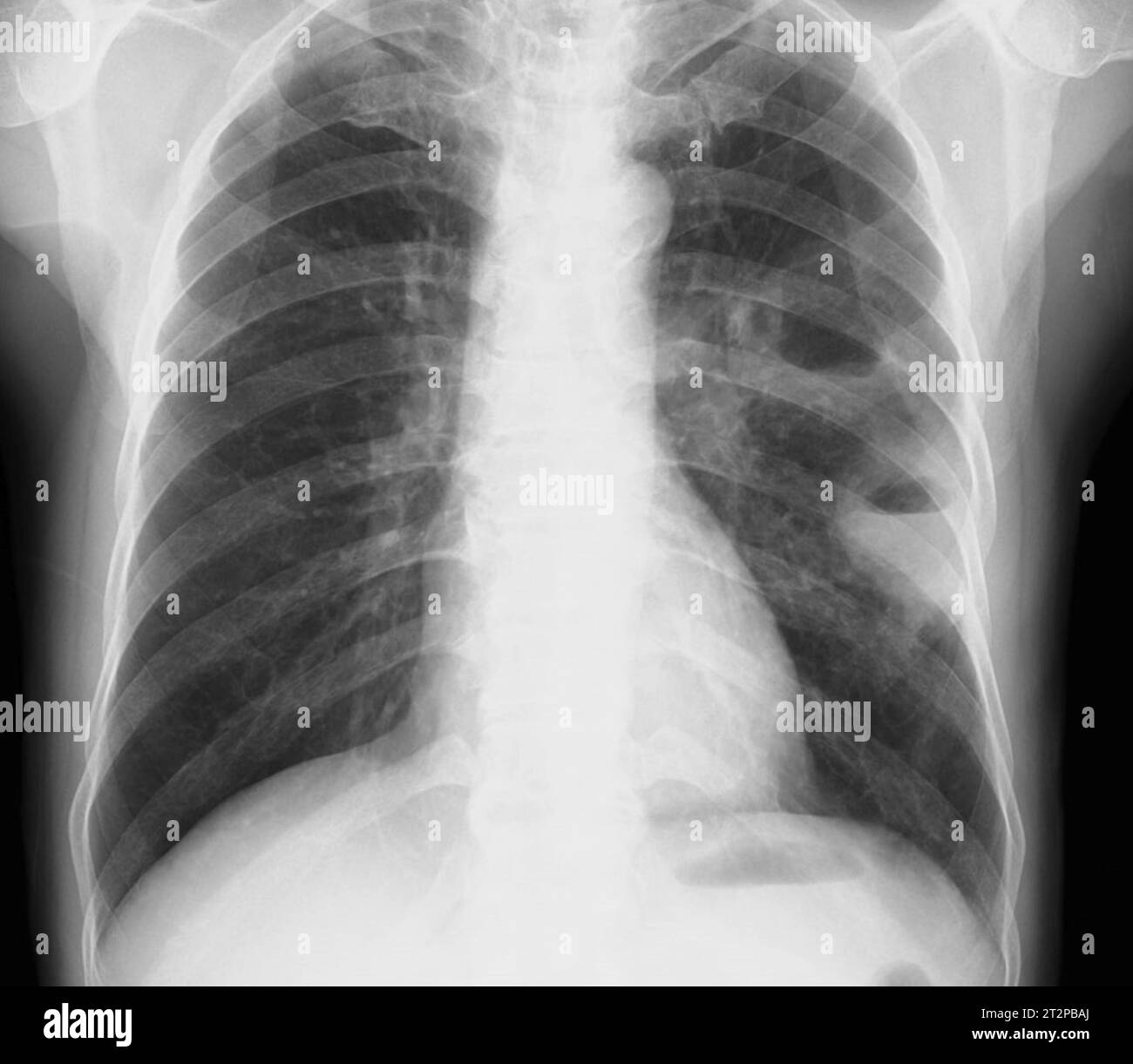 Lung abscesses, X-ray Stock Photo