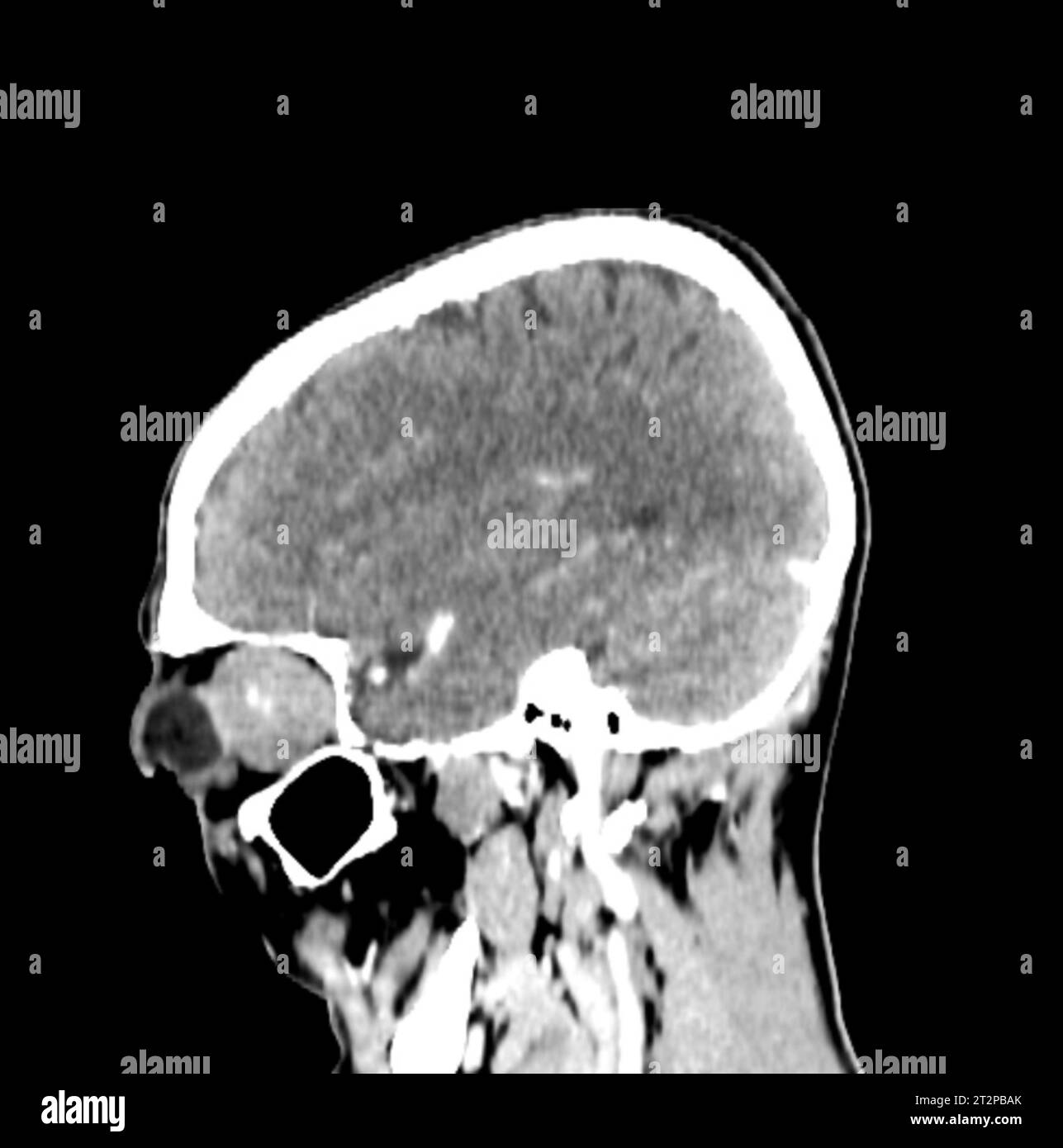 Orbital tumour, CT scan Stock Photo