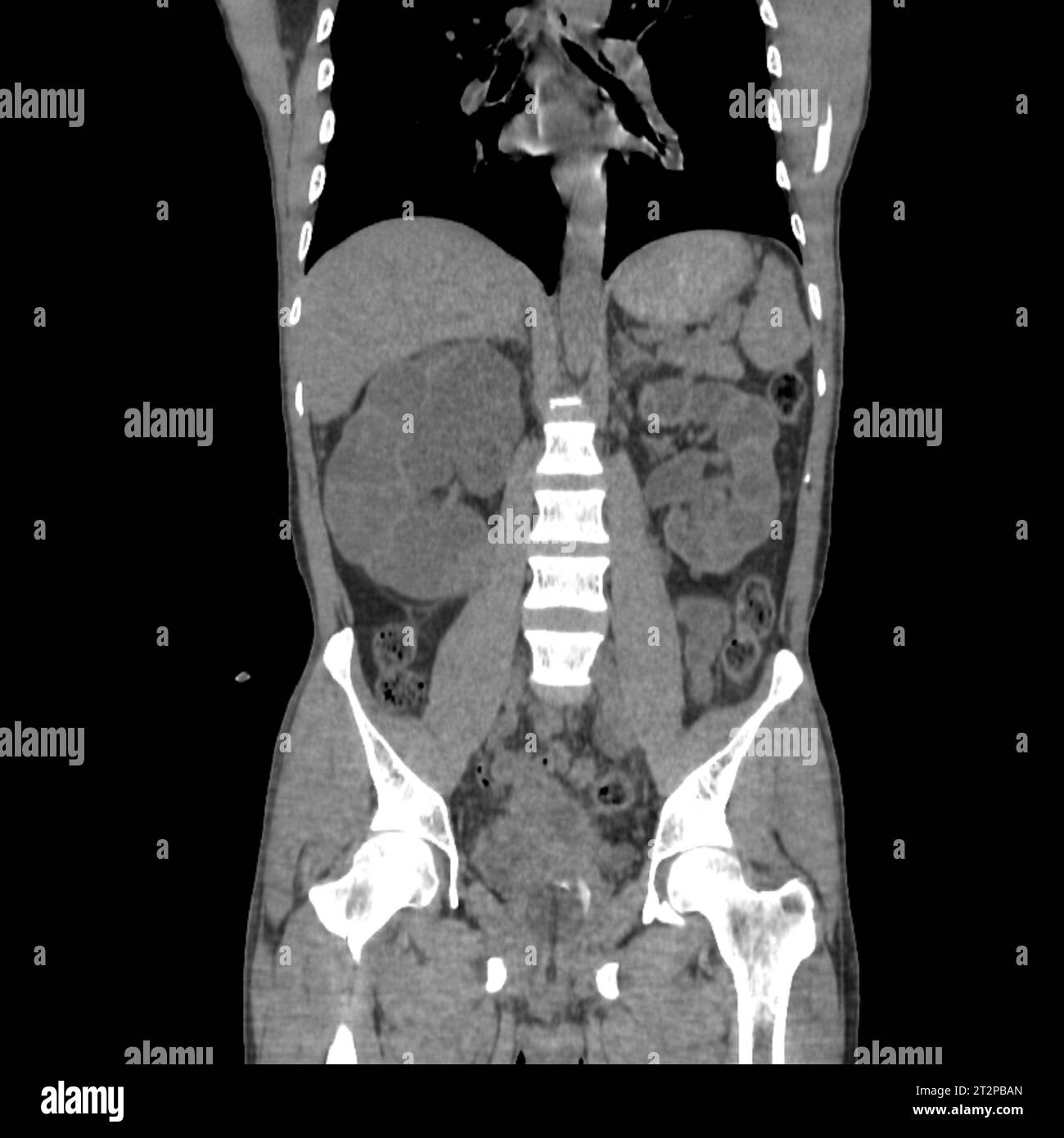Polycystic kidney disease, CT scan Stock Photo