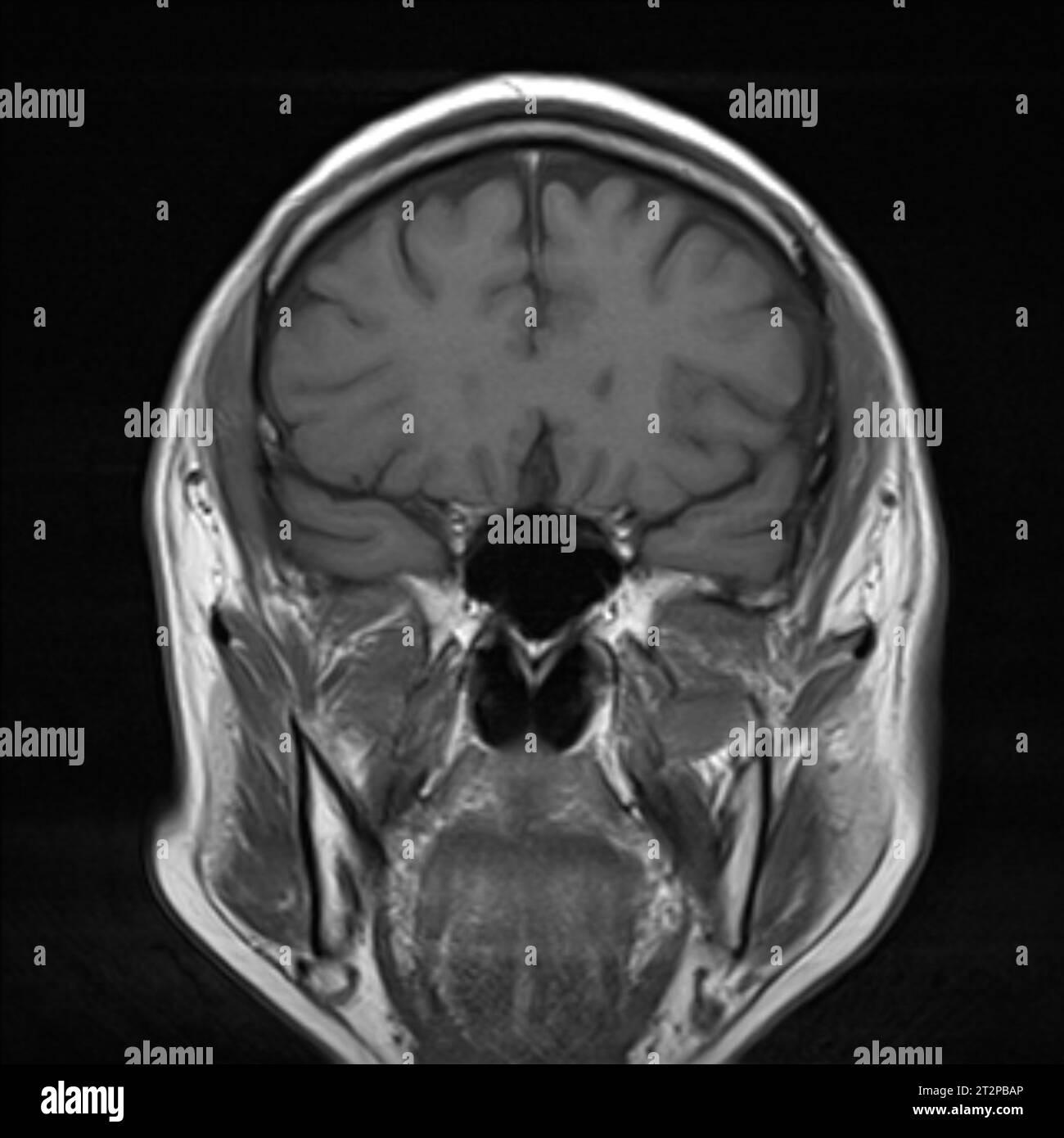 Healthy brain, MRI scan Stock Photo - Alamy