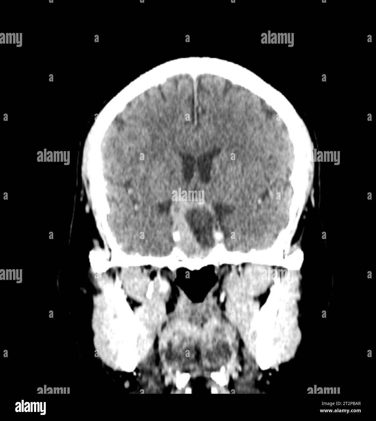 Sellar mass, CT scan Stock Photo