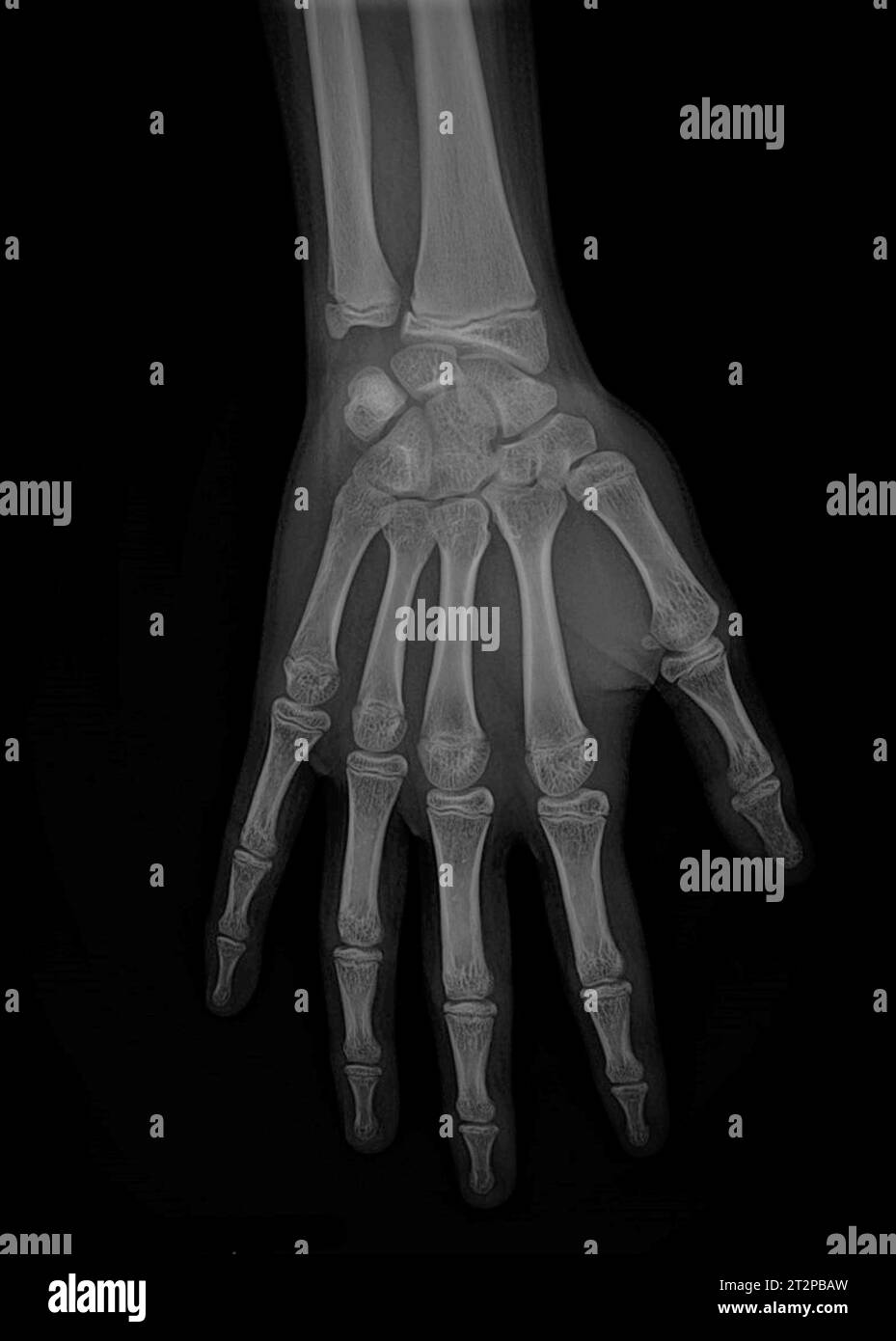 Healthy hand, X-ray Stock Photo