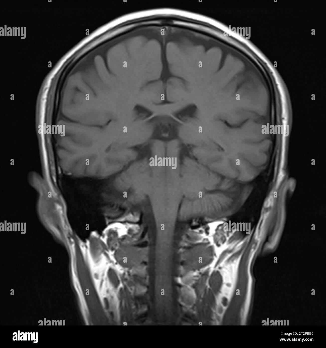 Healthy brain, MRI scan Stock Photo - Alamy